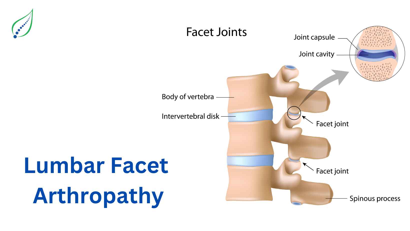 Lumbar Facet Joint Arthropathy